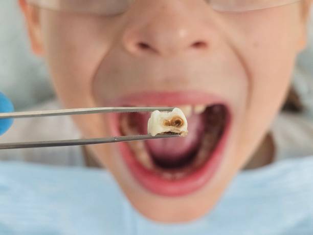Best Emergency Treatment for Oral Infections in Huron, OH